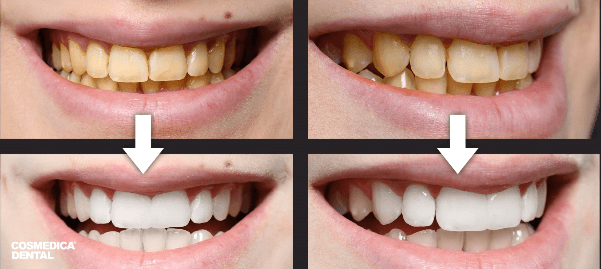 Hollywood Smile en Turquie : étapes, prix et points de vigilance avant de se lancer