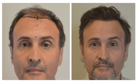 chirurgie greffe cheveux istanbul