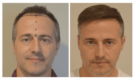 chirurgie greffe cheveux istanbul