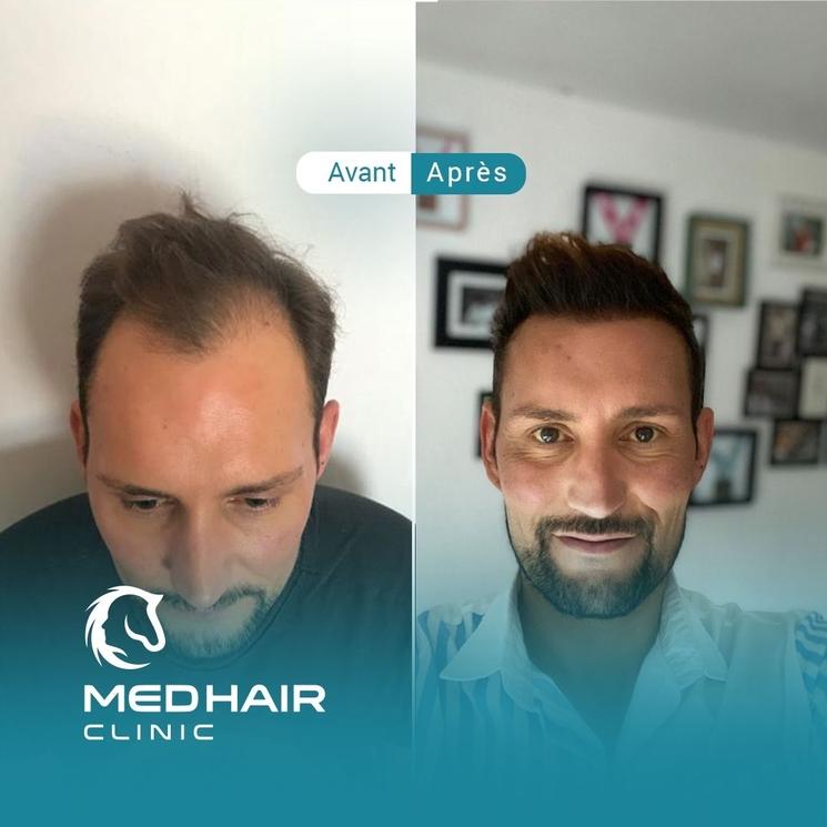 greffe cheveux 