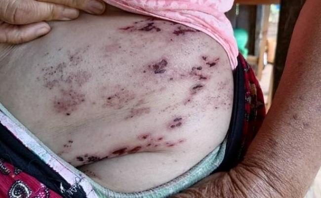 Birmanie maladie de peau déplacés réfugiés Karenni