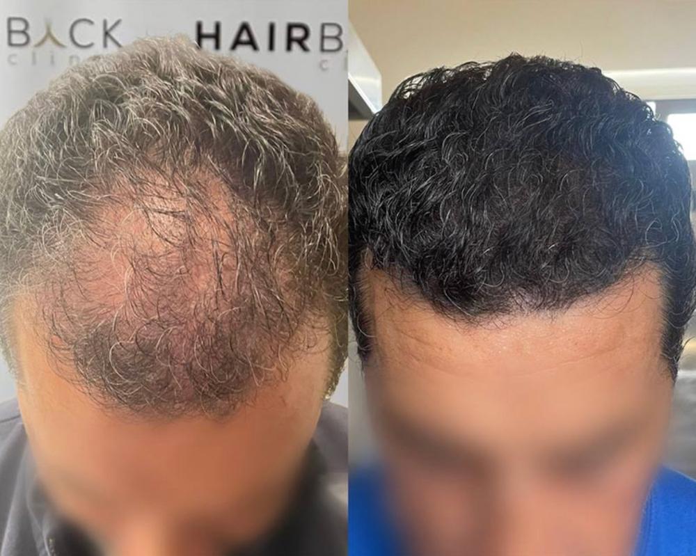 Meilleure clinique de greffe de cheveux - HairBack Clinic_page-0001