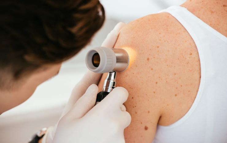 Forte hausse des mélanomes en Europe : les clés d'une protection solaire