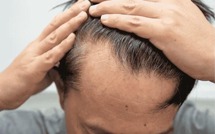 Image montrant le début d'une alopécie chez un homme.w ebp