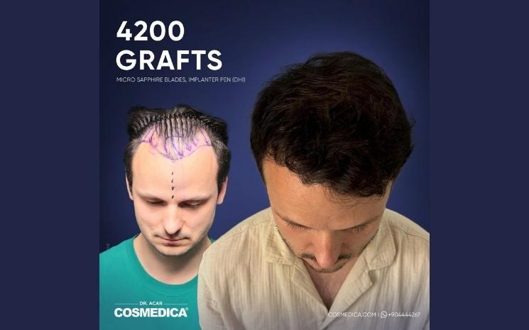 top 5 des cliniques de greffe de cheveux en Turquie