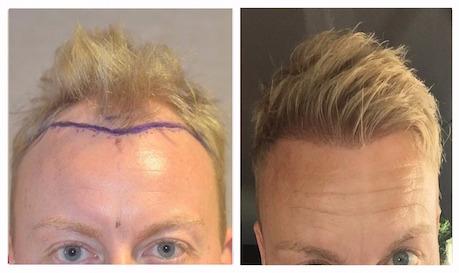 greffe cheveux istanbul