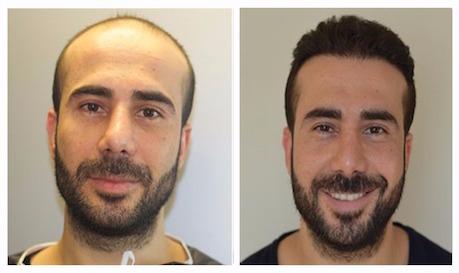 greffe cheveux istanbul