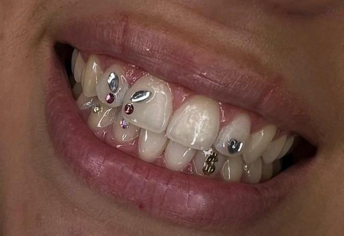 une bouche avec des bijoux dentaires