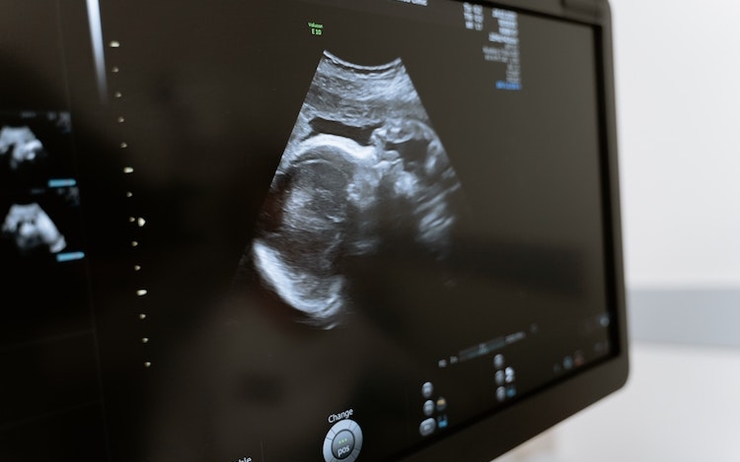Une image d'une échographie d'un enfant né de PMA