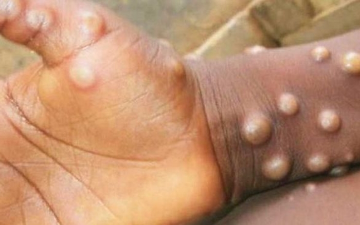 un bras avec pustules caractéristiques de la variole du singe